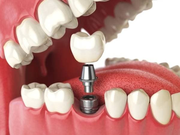 Dental Implants